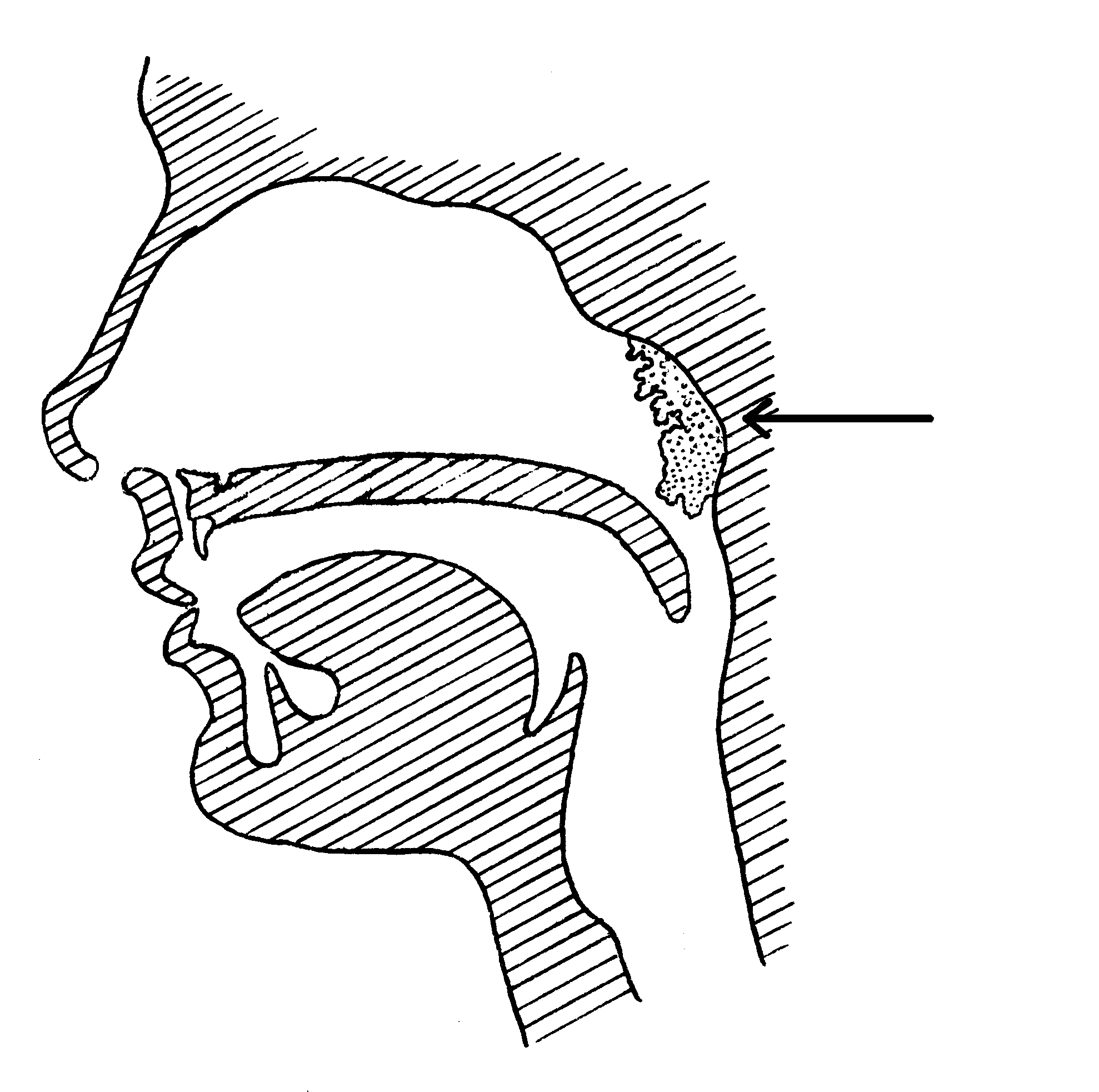 Adenotomia (usunięcie migdałka gardłowego)