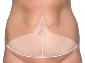 abdominoplastyka wycinanie nadmiaru fałdów skórnych i tkanki tłuszczowej szpital gdańsk 1dayclinic trójmiasto gdynia sopot