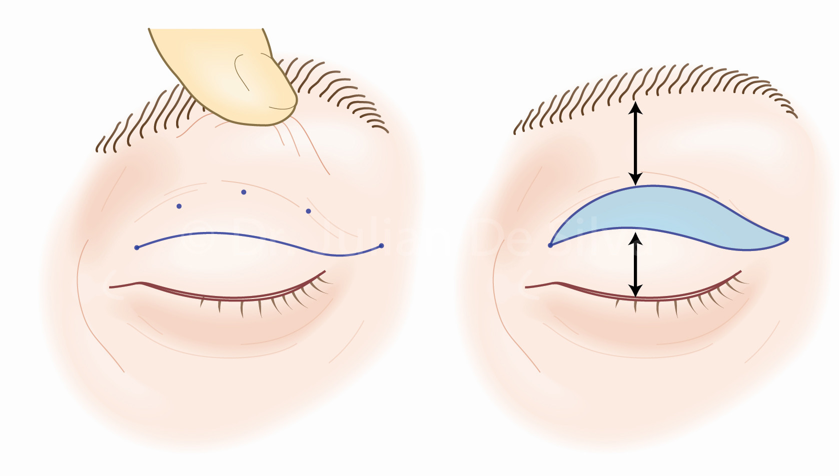 plastyka powiek górnych blefaroplastyka szpita gdańsk 1dayclinic