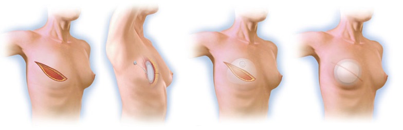 rekonstrukcja piersi po amputacji za pomocą ekspandera 1dayclinic szpital gdańsk