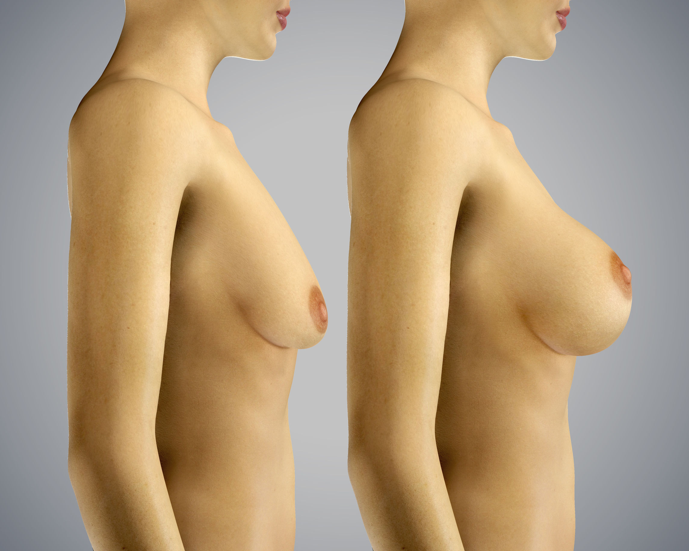 Powiększenie piersi (tłuszczem pacjentki)